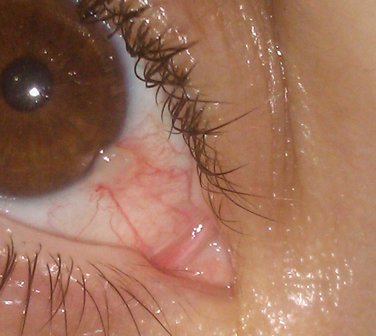 Dipyridamol oogdruppels